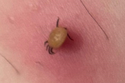 "Kene ısırığı belirtisiz başlar, hızla ağırlaşabilir"